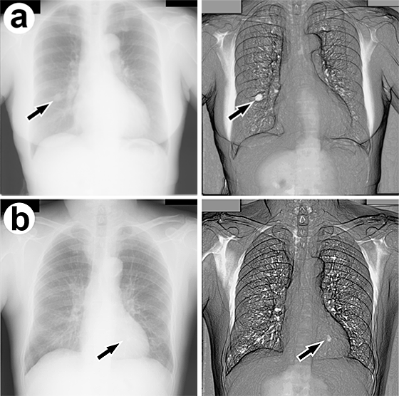 胸部単純X線画像における肺結節領域の強調処理結果